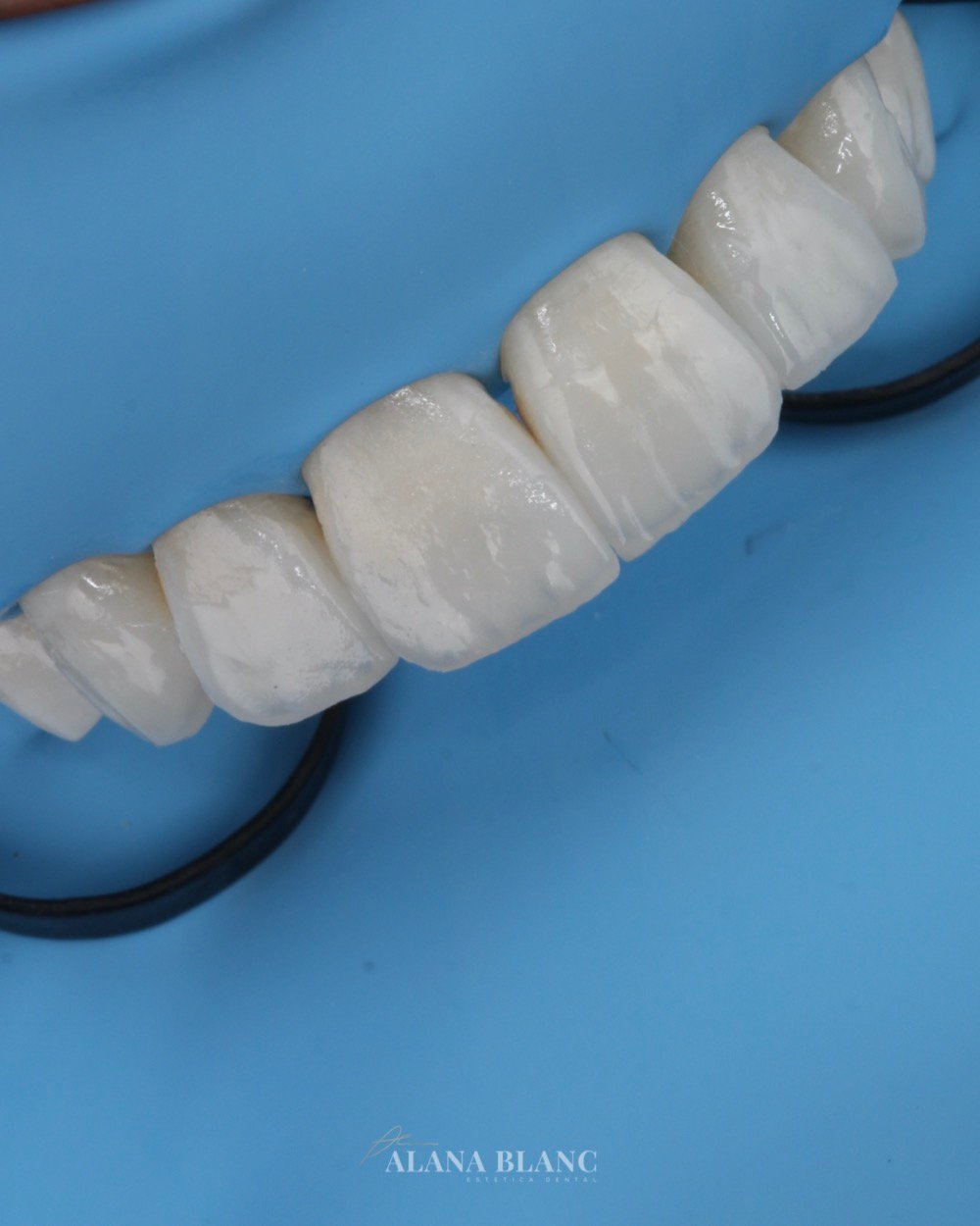 Estratificación y efectos ópticos incisales — Día 1, Excelencia en Resinas